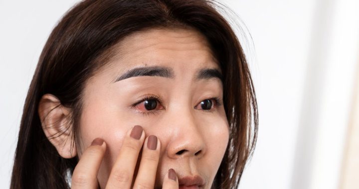 pink eye vs. allergies